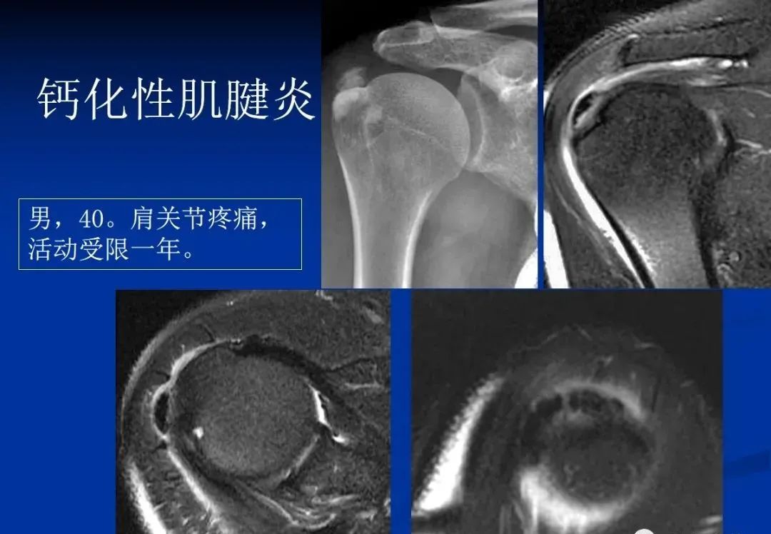 影像PPT - 肩袖解剖及损伤的临床及MRI诊断-158 影像PPT - 肩袖解剖及损伤的临床及MRI诊断-158