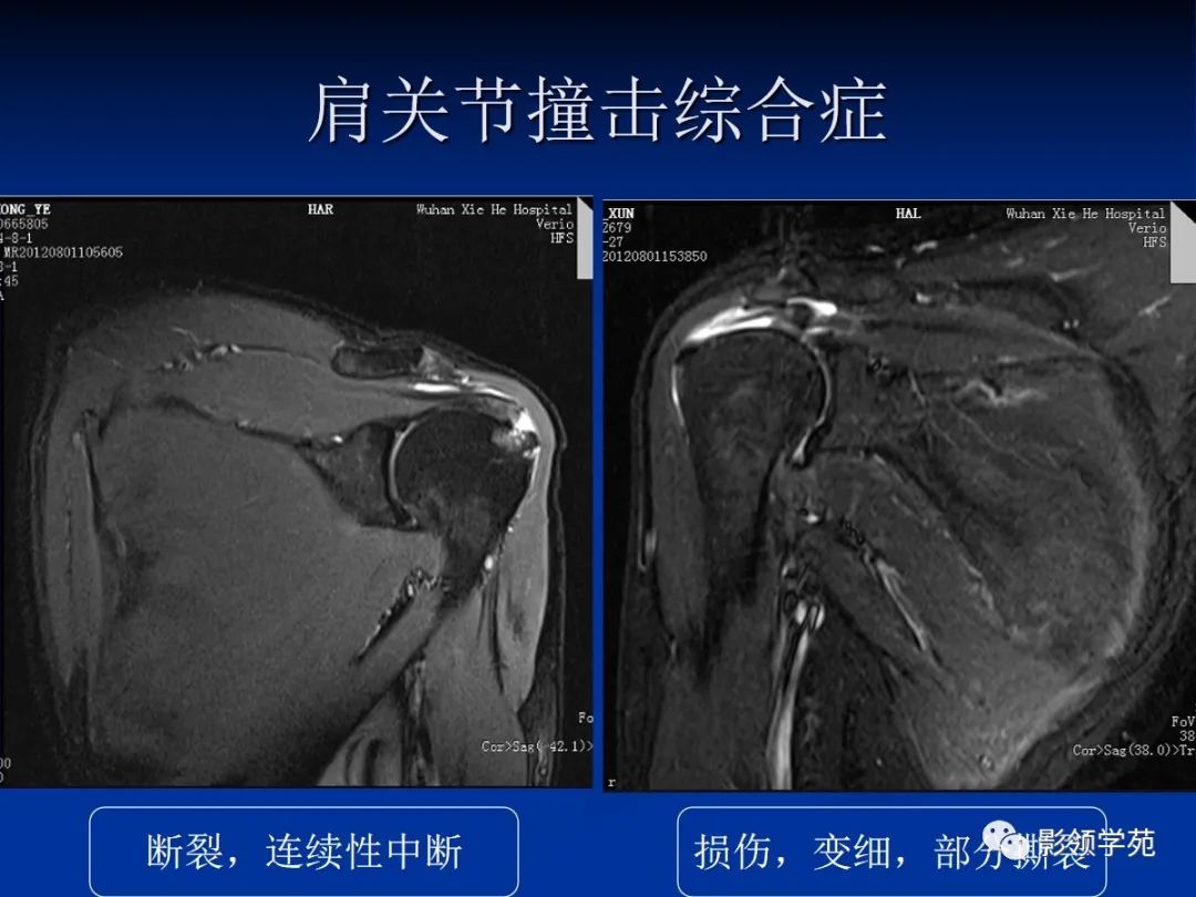影像PPT - 肩袖解剖及损伤的临床及MRI诊断-160 影像PPT - 肩袖解剖及损伤的临床及MRI诊断-160