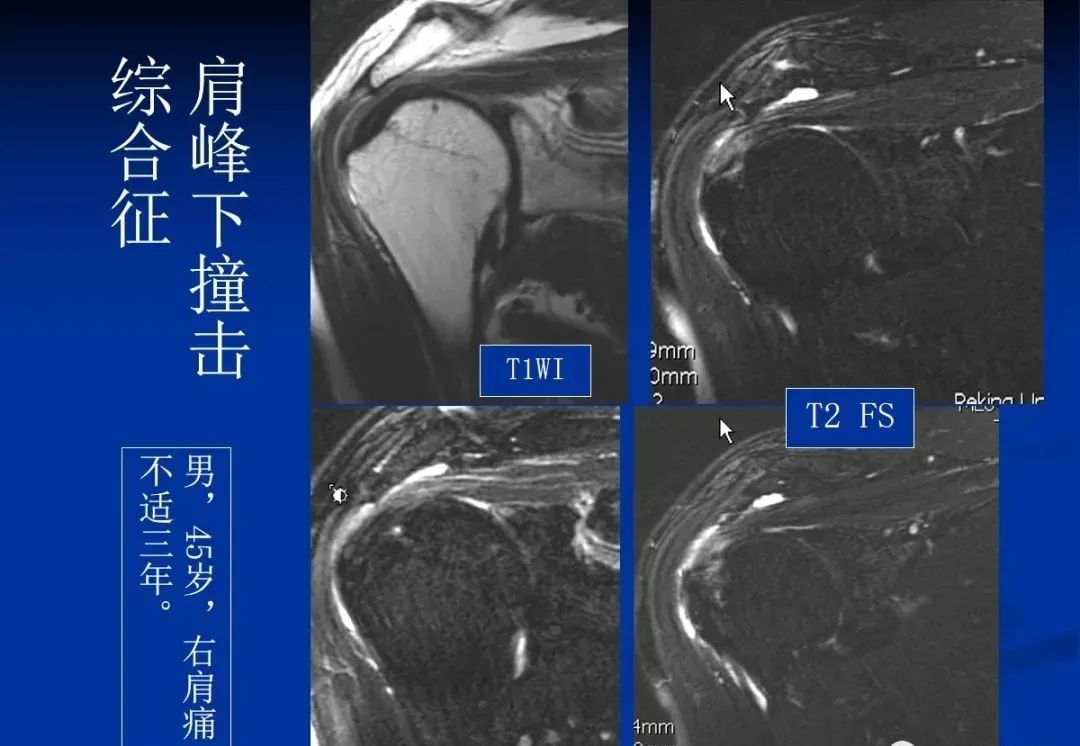 影像PPT - 肩袖解剖及损伤的临床及MRI诊断-161 影像PPT - 肩袖解剖及损伤的临床及MRI诊断-161