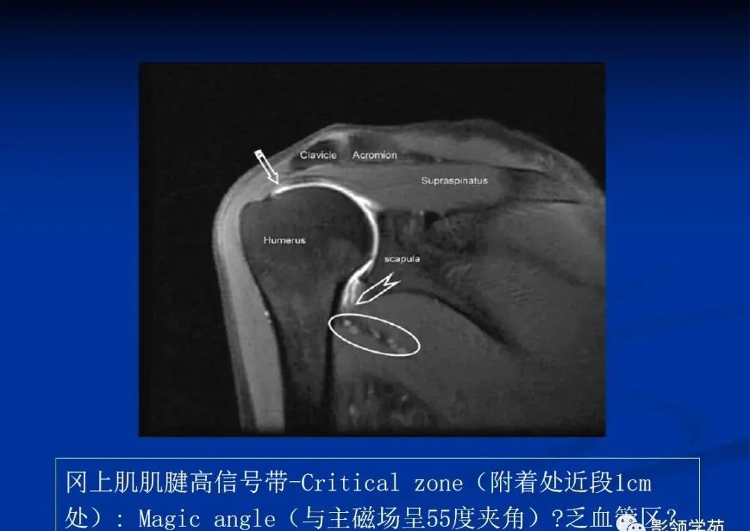 影像PPT - 肩袖解剖及损伤的临床及MRI诊断-163 影像PPT - 肩袖解剖及损伤的临床及MRI诊断-163