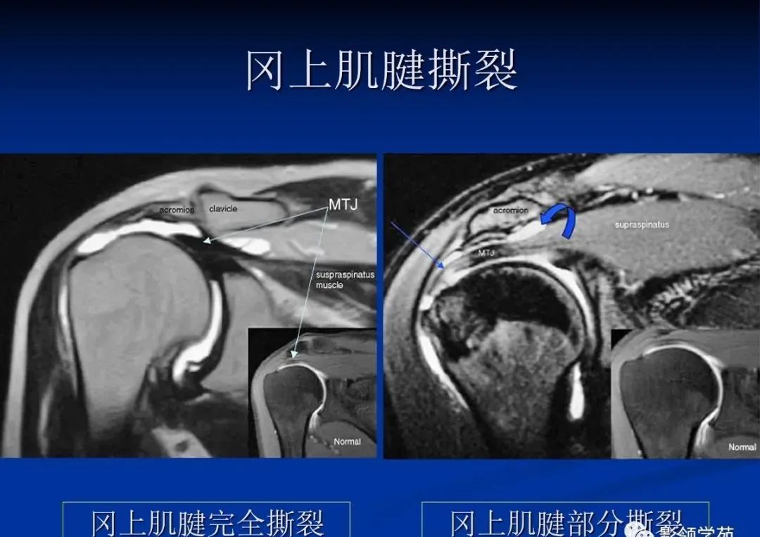 影像PPT - 肩袖解剖及损伤的临床及MRI诊断-164 影像PPT - 肩袖解剖及损伤的临床及MRI诊断-164