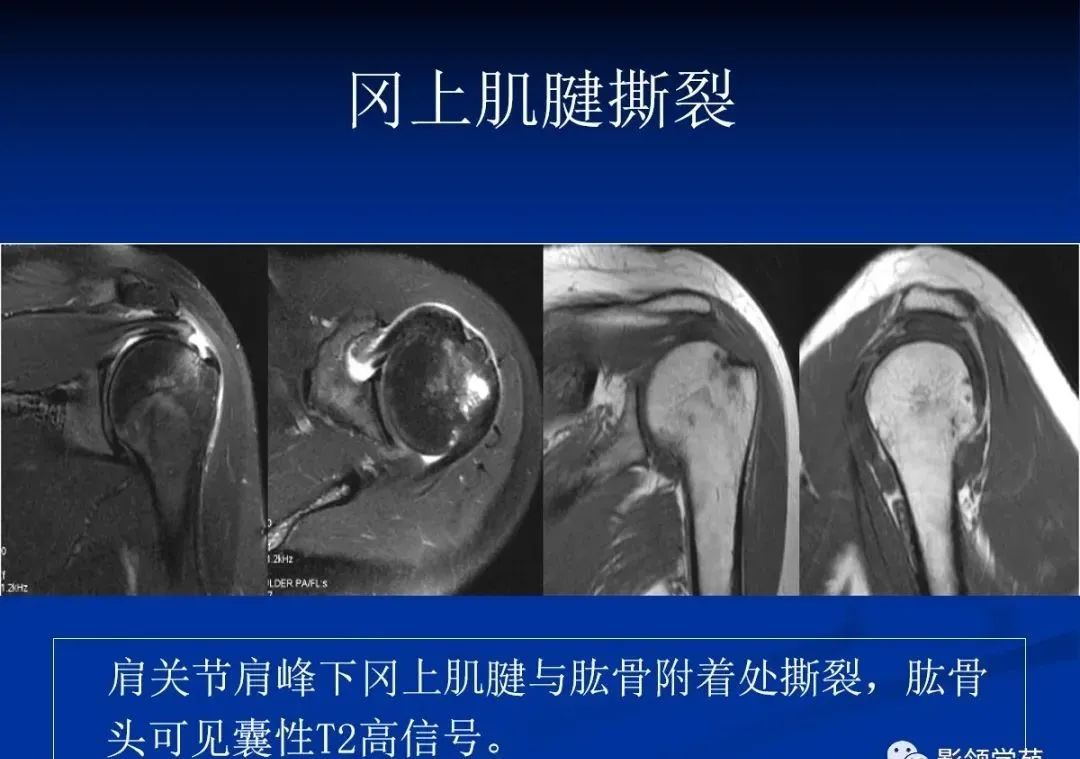 影像PPT - 肩袖解剖及损伤的临床及MRI诊断-165 影像PPT - 肩袖解剖及损伤的临床及MRI诊断-165