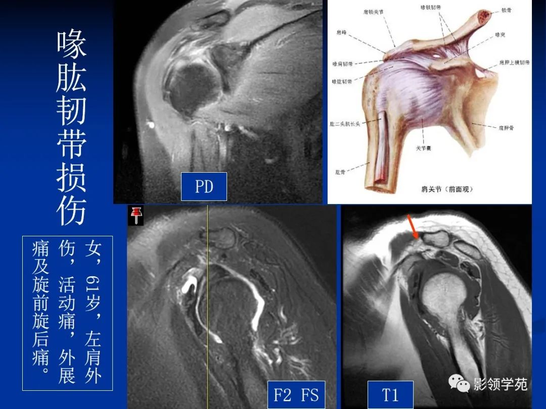 影像PPT - 肩袖解剖及损伤的临床及MRI诊断-166 影像PPT - 肩袖解剖及损伤的临床及MRI诊断-166