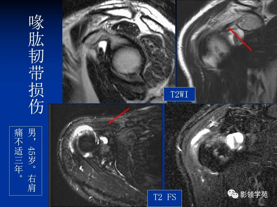 影像PPT - 肩袖解剖及损伤的临床及MRI诊断-167 影像PPT - 肩袖解剖及损伤的临床及MRI诊断-167