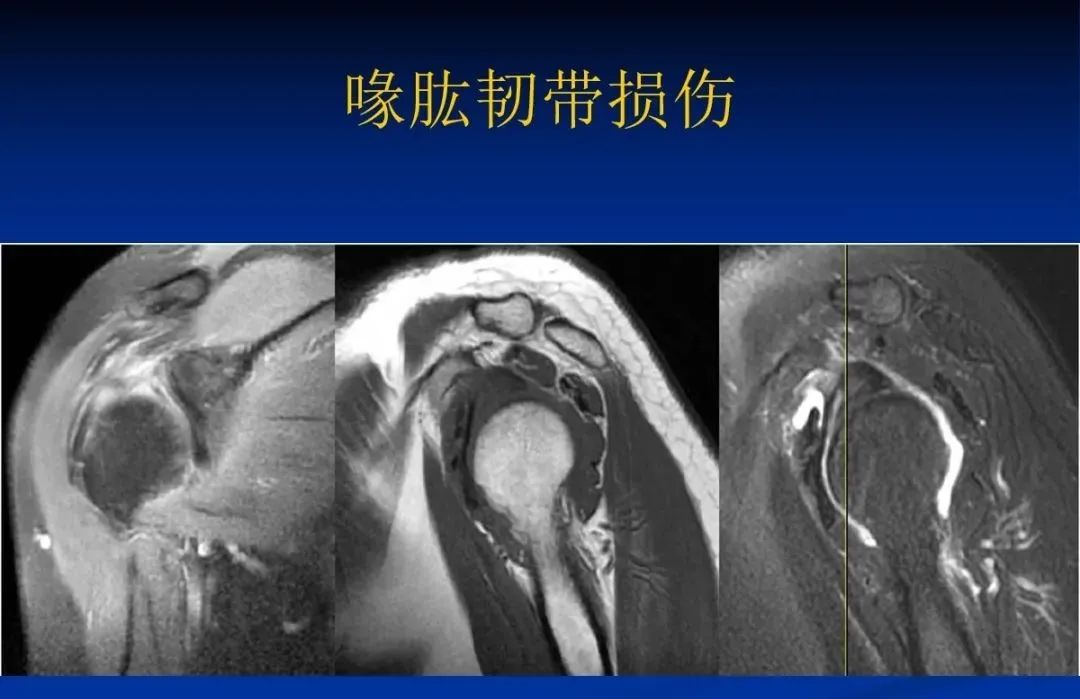 影像PPT - 肩袖解剖及损伤的临床及MRI诊断-168 影像PPT - 肩袖解剖及损伤的临床及MRI诊断-168