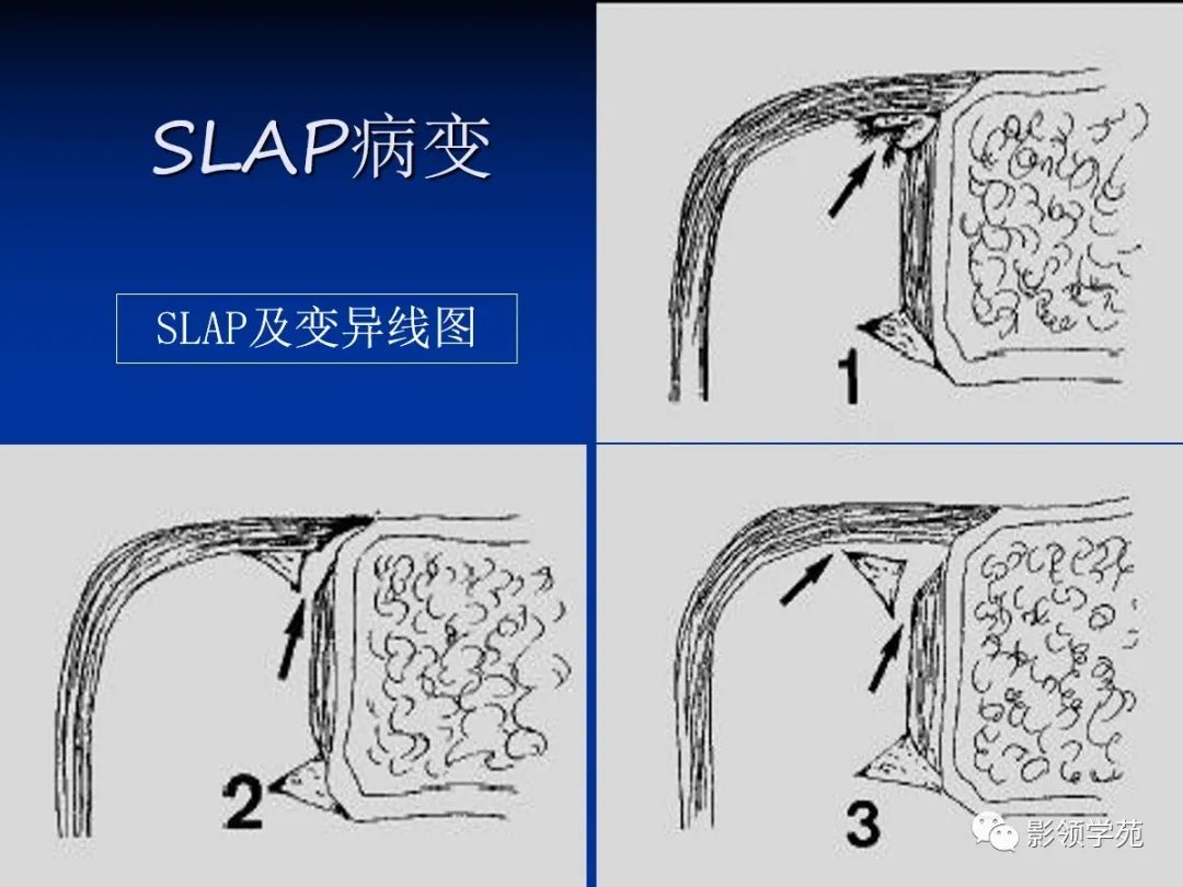 影像PPT - 肩袖解剖及损伤的临床及MRI诊断-173 影像PPT - 肩袖解剖及损伤的临床及MRI诊断-173