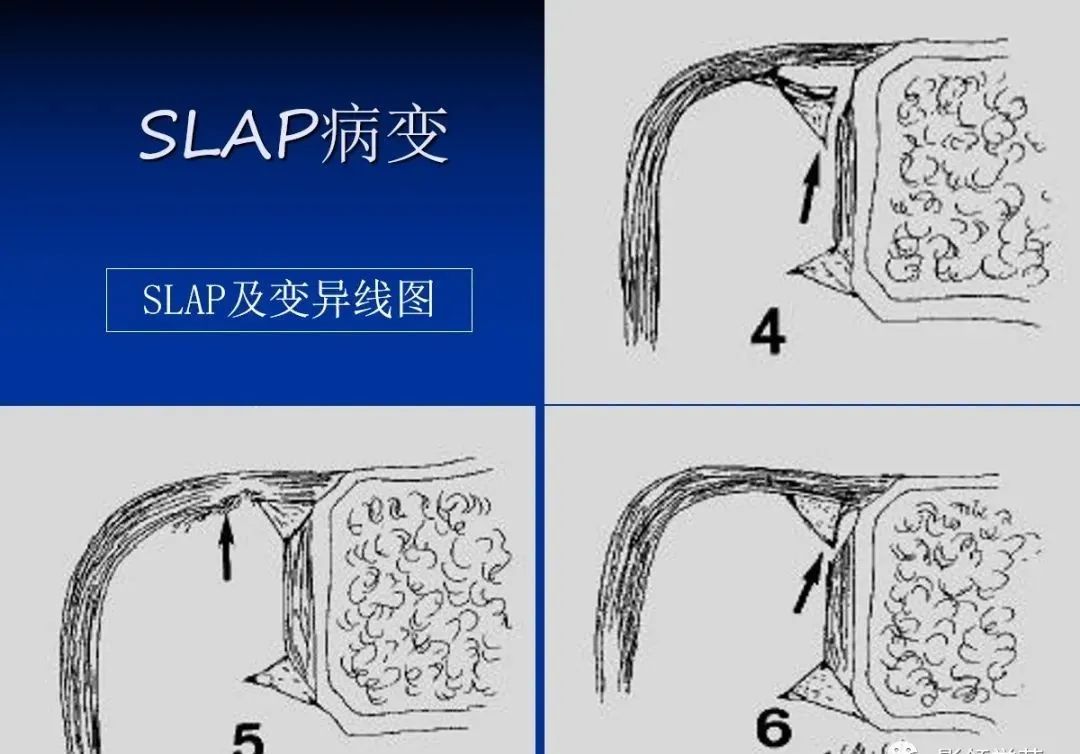 影像PPT - 肩袖解剖及损伤的临床及MRI诊断-174 影像PPT - 肩袖解剖及损伤的临床及MRI诊断-174