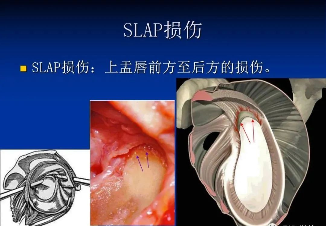 影像PPT - 肩袖解剖及损伤的临床及MRI诊断-175 影像PPT - 肩袖解剖及损伤的临床及MRI诊断-175