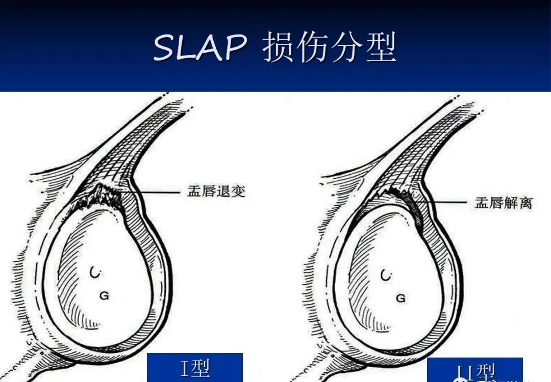 影像PPT - 肩袖解剖及损伤的临床及MRI诊断-177 影像PPT - 肩袖解剖及损伤的临床及MRI诊断-177