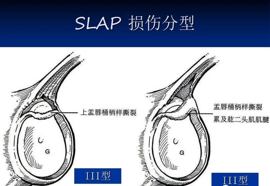 影像PPT - 肩袖解剖及损伤的临床及MRI诊断-178 影像PPT - 肩袖解剖及损伤的临床及MRI诊断-178