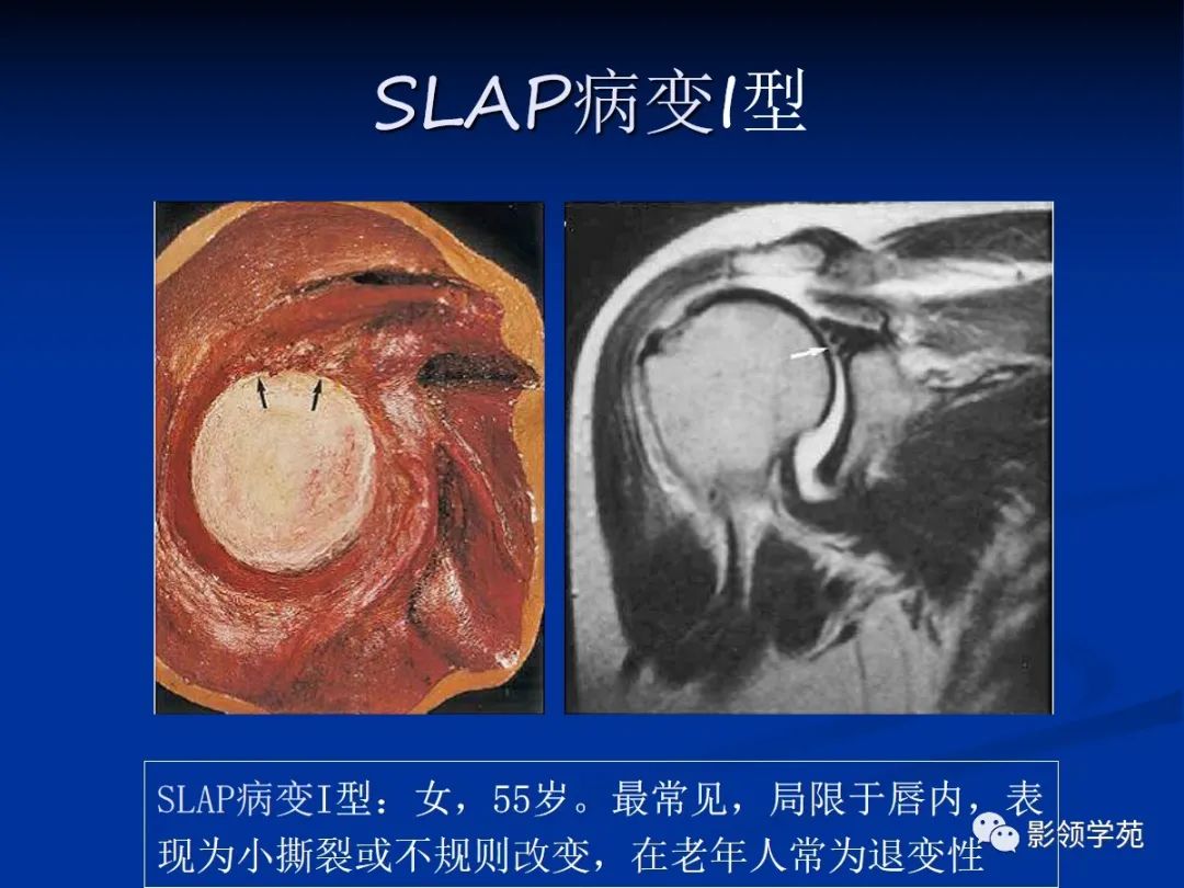 影像PPT - 肩袖解剖及损伤的临床及MRI诊断-179 影像PPT - 肩袖解剖及损伤的临床及MRI诊断-179