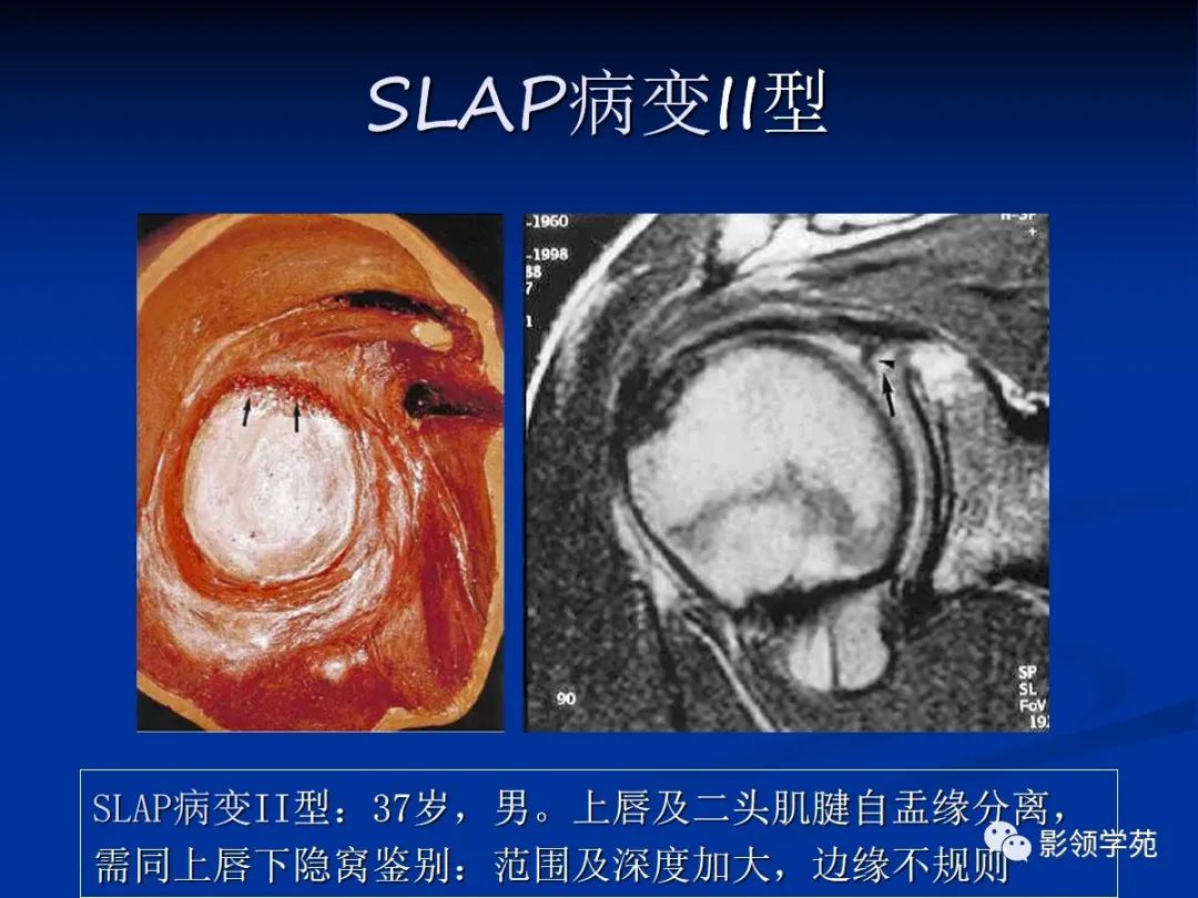 影像PPT - 肩袖解剖及损伤的临床及MRI诊断-180 影像PPT - 肩袖解剖及损伤的临床及MRI诊断-180