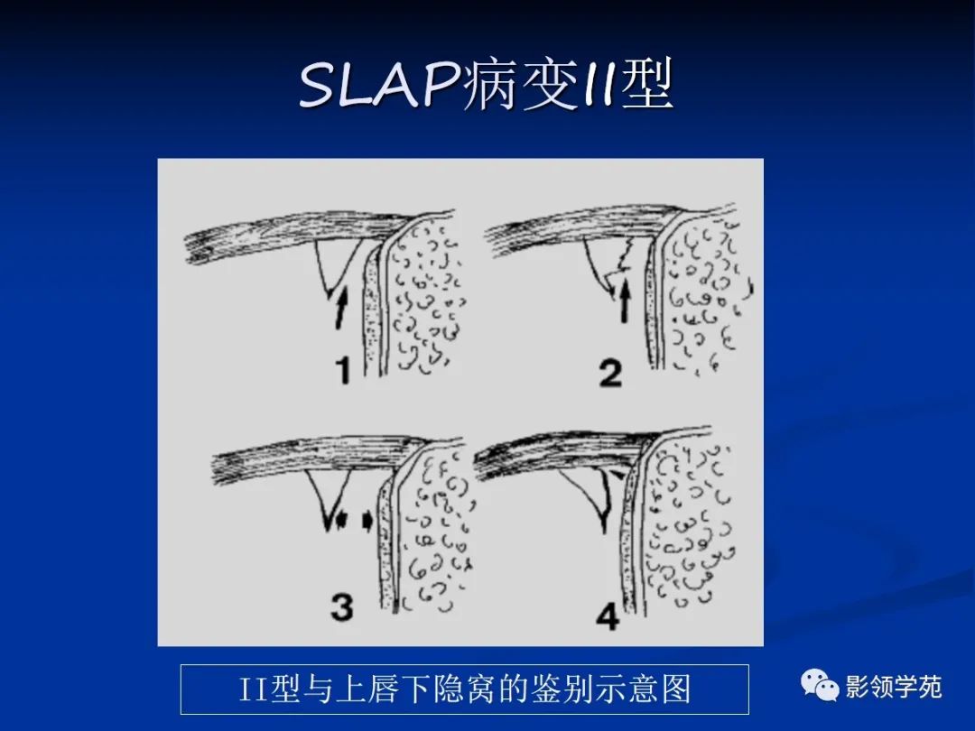 影像PPT - 肩袖解剖及损伤的临床及MRI诊断-181 影像PPT - 肩袖解剖及损伤的临床及MRI诊断-181