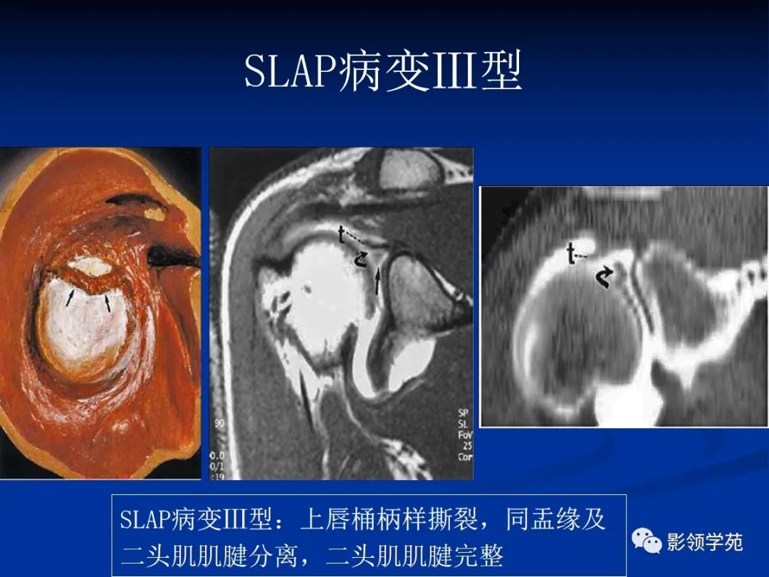 影像PPT - 肩袖解剖及损伤的临床及MRI诊断-182 影像PPT - 肩袖解剖及损伤的临床及MRI诊断-182