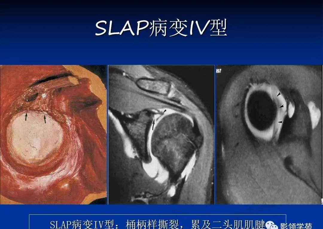 影像PPT - 肩袖解剖及损伤的临床及MRI诊断-183 影像PPT - 肩袖解剖及损伤的临床及MRI诊断-183