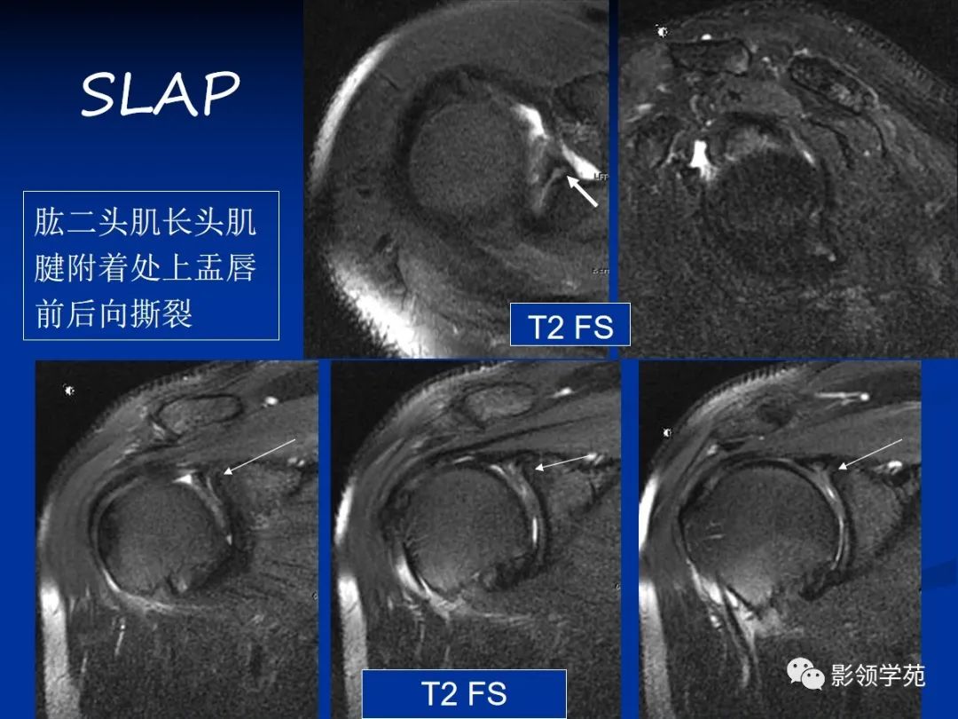 影像PPT - 肩袖解剖及损伤的临床及MRI诊断-184 影像PPT - 肩袖解剖及损伤的临床及MRI诊断-184