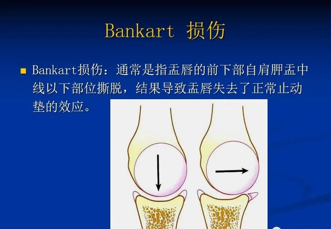影像PPT - 肩袖解剖及损伤的临床及MRI诊断-186 影像PPT - 肩袖解剖及损伤的临床及MRI诊断-186