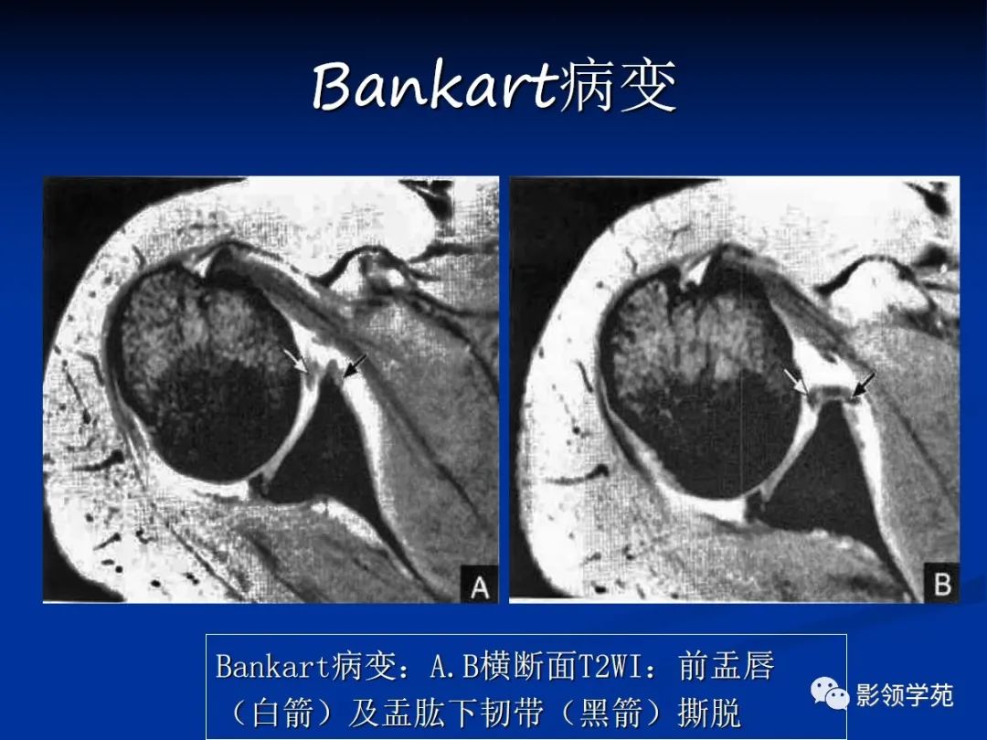 影像PPT - 肩袖解剖及损伤的临床及MRI诊断-188 影像PPT - 肩袖解剖及损伤的临床及MRI诊断-188