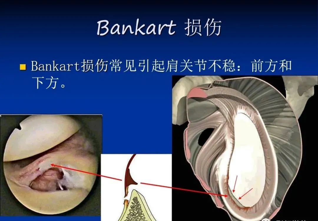 影像PPT - 肩袖解剖及损伤的临床及MRI诊断-187 影像PPT - 肩袖解剖及损伤的临床及MRI诊断-187