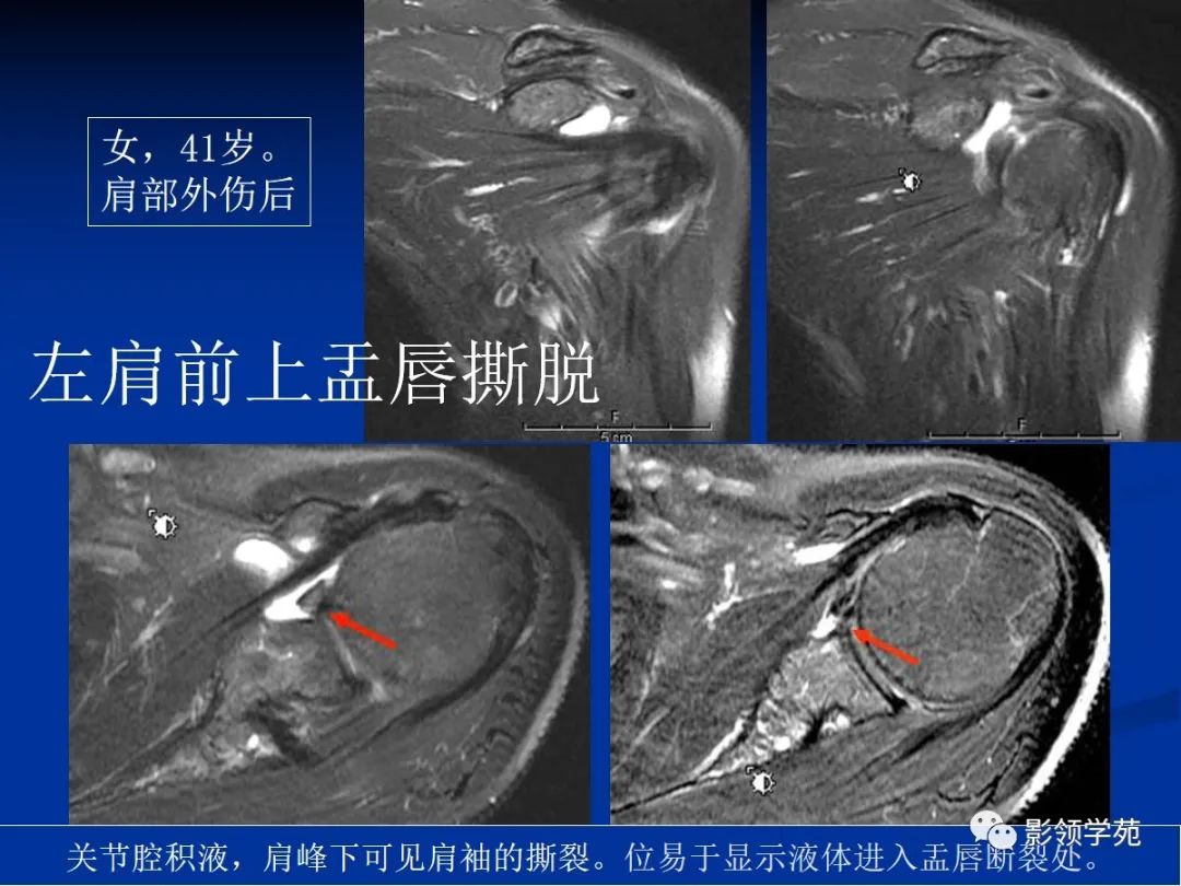 影像PPT - 肩袖解剖及损伤的临床及MRI诊断-189 影像PPT - 肩袖解剖及损伤的临床及MRI诊断-189