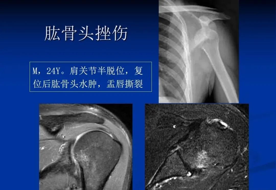 影像PPT - 肩袖解剖及损伤的临床及MRI诊断-190 影像PPT - 肩袖解剖及损伤的临床及MRI诊断-190