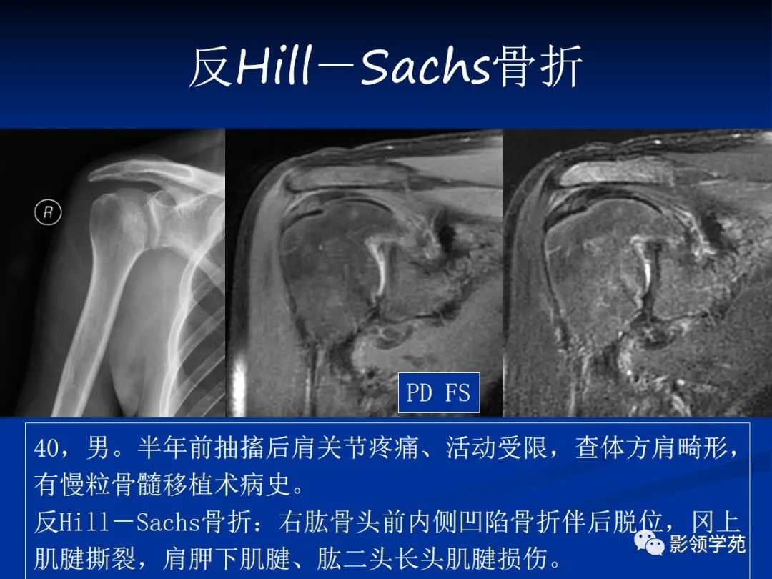 影像PPT - 肩袖解剖及损伤的临床及MRI诊断-191 影像PPT - 肩袖解剖及损伤的临床及MRI诊断-191