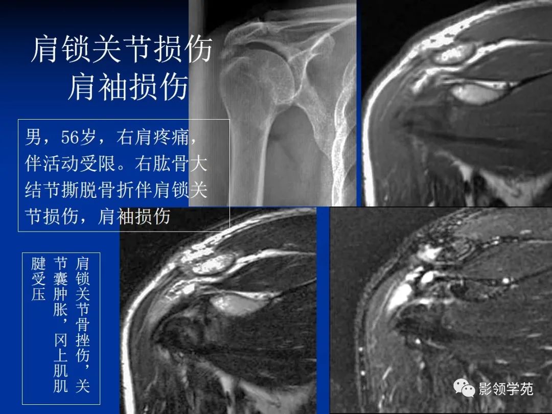 影像PPT - 肩袖解剖及损伤的临床及MRI诊断-194 影像PPT - 肩袖解剖及损伤的临床及MRI诊断-194