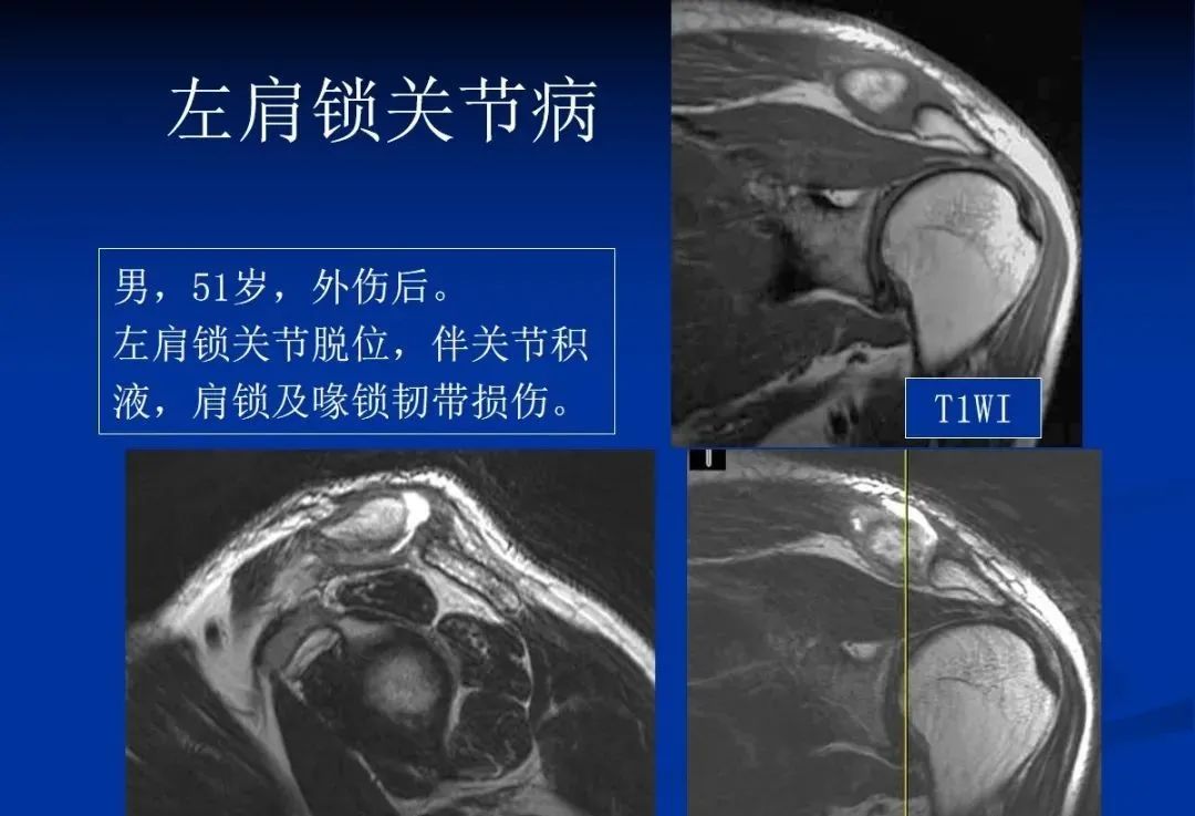 影像PPT - 肩袖解剖及损伤的临床及MRI诊断-193 影像PPT - 肩袖解剖及损伤的临床及MRI诊断-193