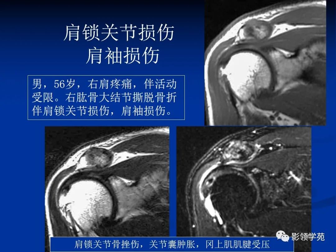 影像PPT - 肩袖解剖及损伤的临床及MRI诊断-195 影像PPT - 肩袖解剖及损伤的临床及MRI诊断-195