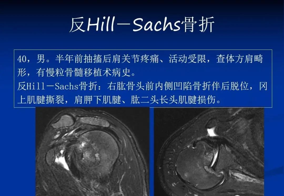 影像PPT - 肩袖解剖及损伤的临床及MRI诊断-192 影像PPT - 肩袖解剖及损伤的临床及MRI诊断-192
