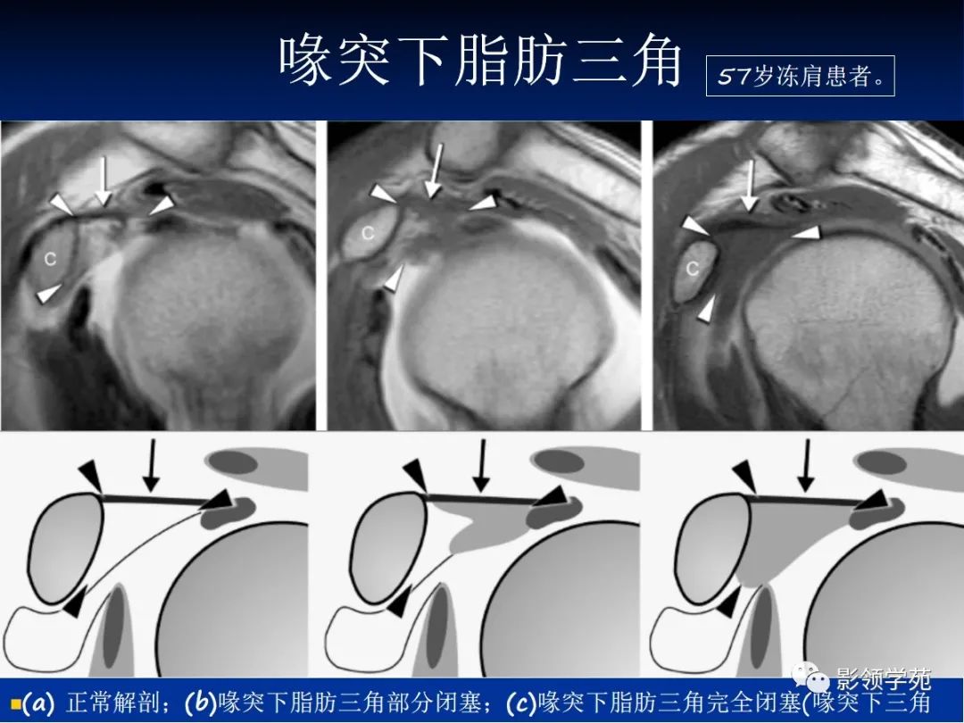 影像PPT - 肩袖解剖及损伤的临床及MRI诊断-198 影像PPT - 肩袖解剖及损伤的临床及MRI诊断-198