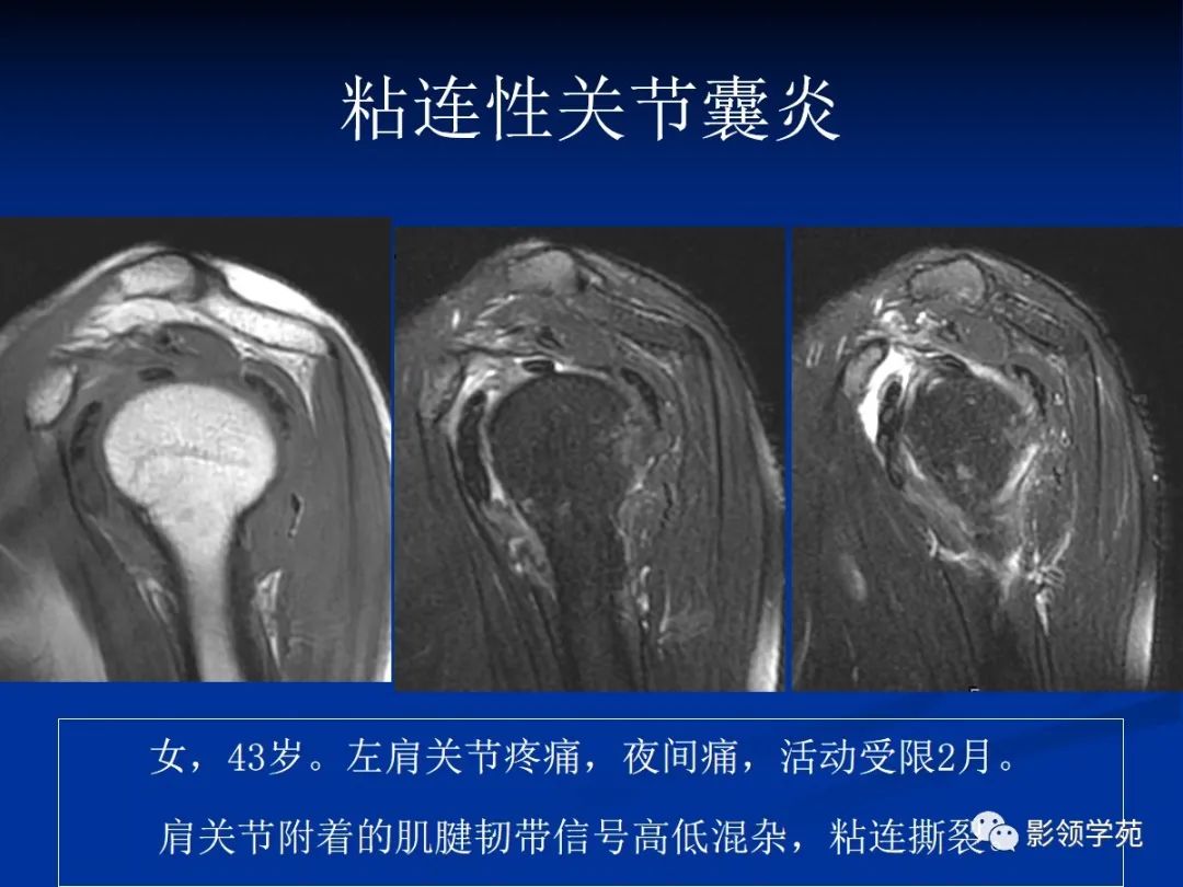 影像PPT - 肩袖解剖及损伤的临床及MRI诊断-199 影像PPT - 肩袖解剖及损伤的临床及MRI诊断-199