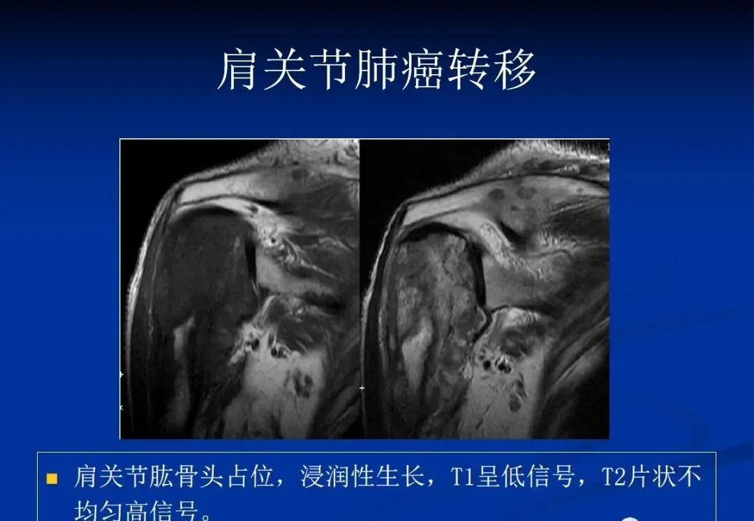 影像PPT - 肩袖解剖及损伤的临床及MRI诊断-200 影像PPT - 肩袖解剖及损伤的临床及MRI诊断-200