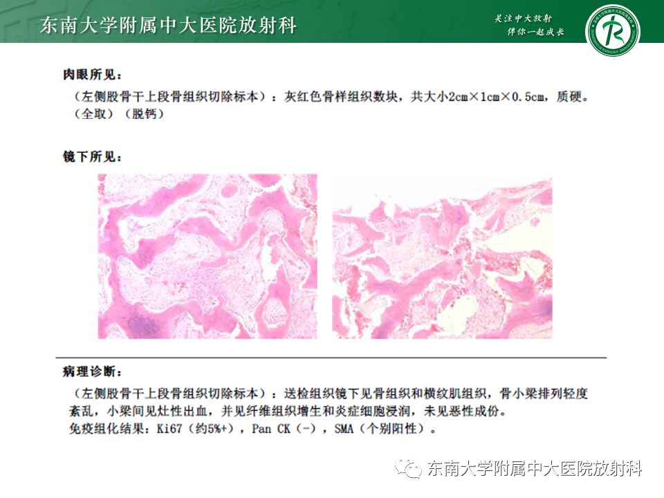 影像PPT - 【PPT】骨纤维异常增殖症-4