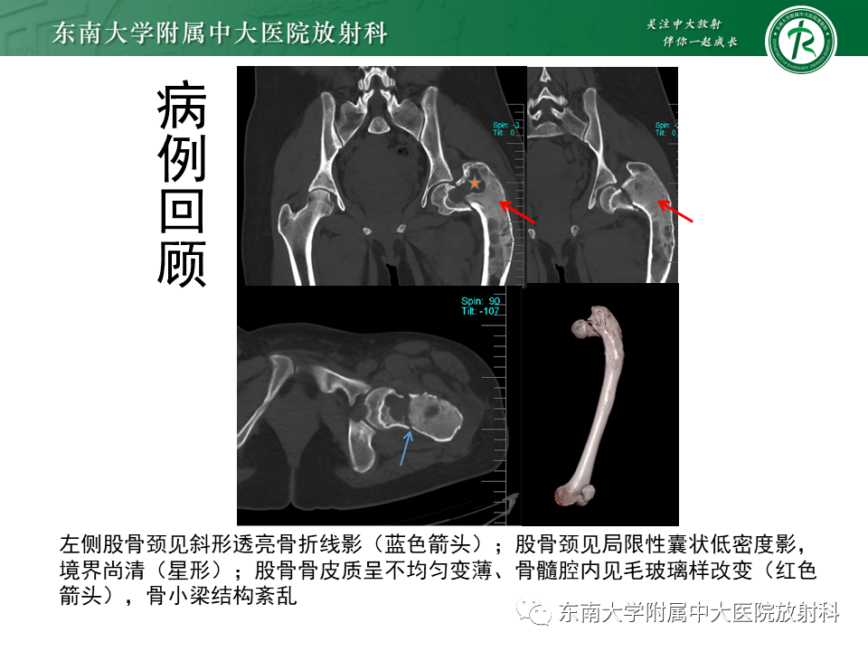 影像PPT - 【PPT】骨纤维异常增殖症-3