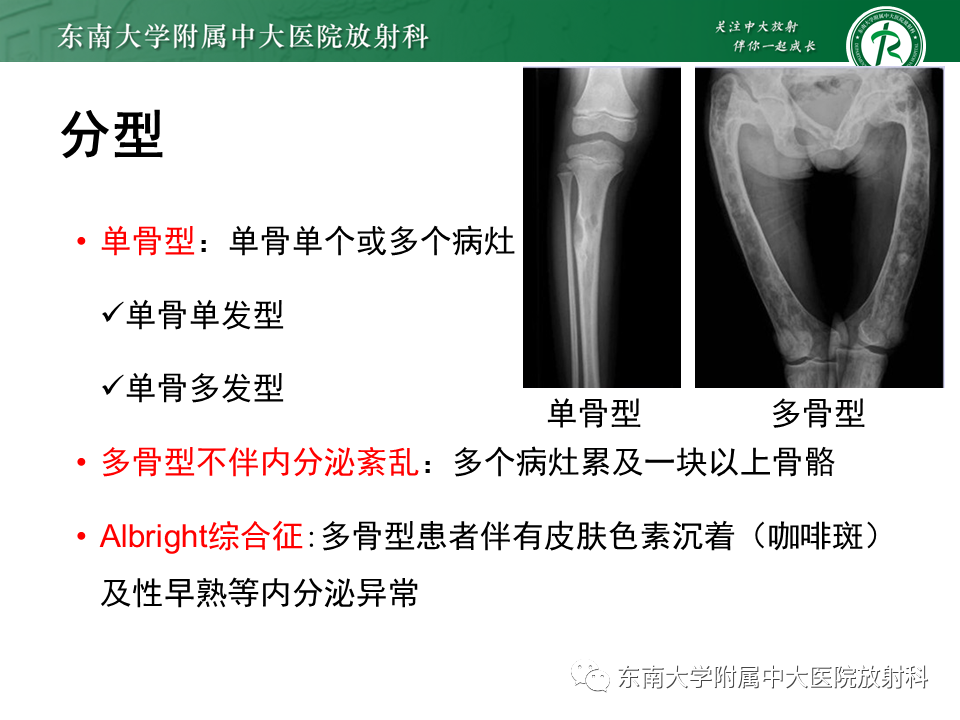 影像PPT - 【PPT】骨纤维异常增殖症-8