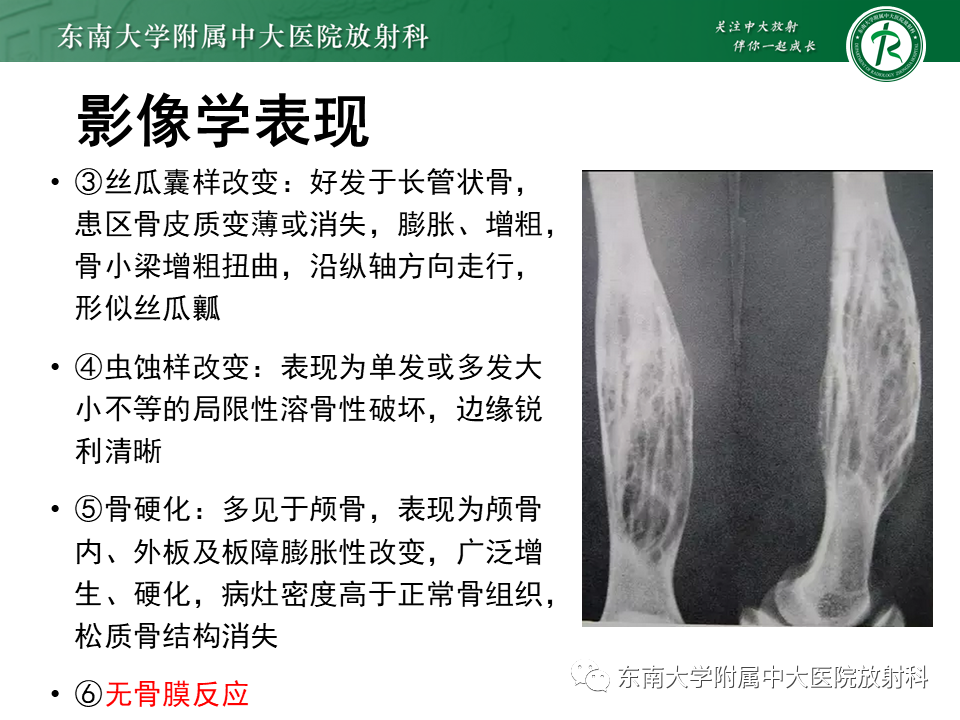 影像PPT - 【PPT】骨纤维异常增殖症-10