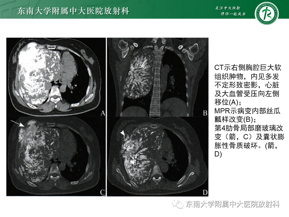 影像PPT - 【PPT】骨纤维异常增殖症-11