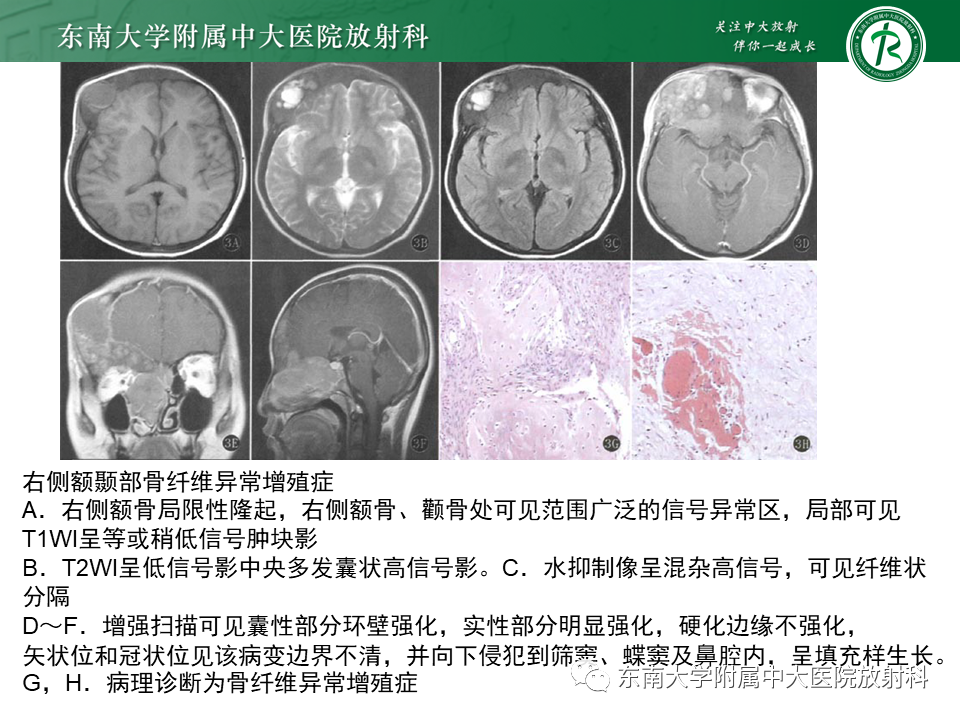 影像PPT - 【PPT】骨纤维异常增殖症-12