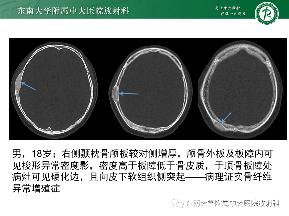 影像PPT - 【PPT】骨纤维异常增殖症-13