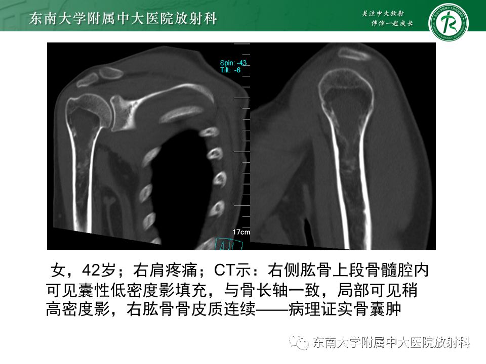 影像PPT - 【PPT】骨纤维异常增殖症-15