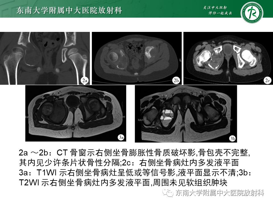 影像PPT - 【PPT】骨纤维异常增殖症-17