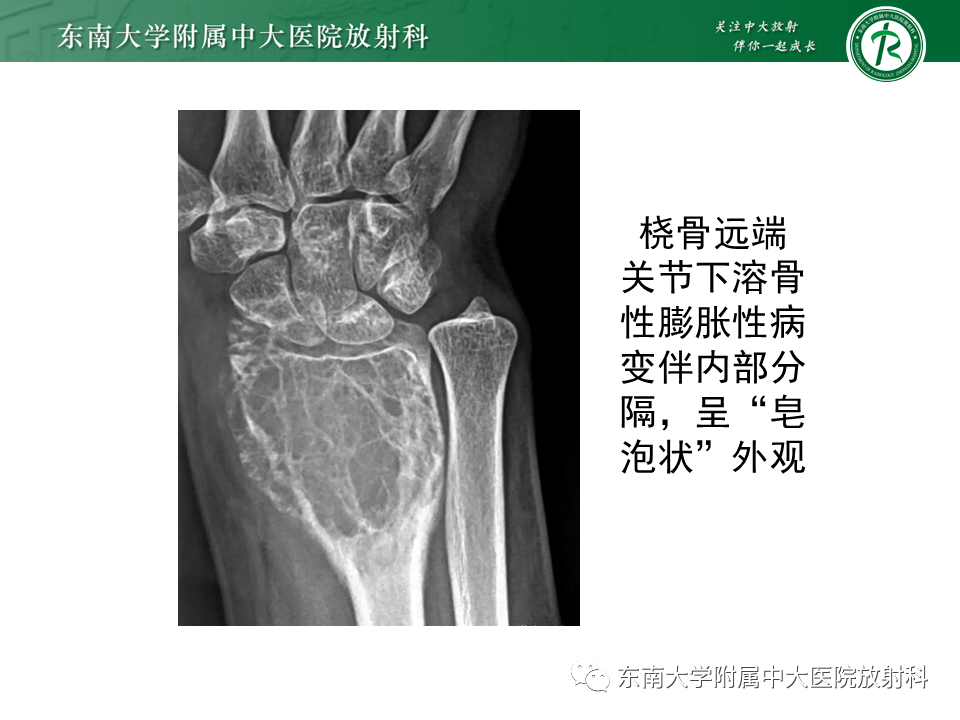 影像PPT - 【PPT】骨纤维异常增殖症-19