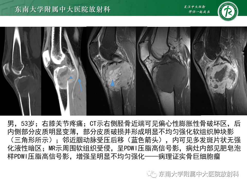 影像PPT - 【PPT】骨纤维异常增殖症-20