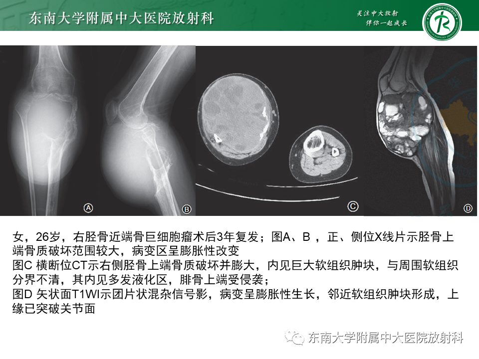 影像PPT - 【PPT】骨纤维异常增殖症-21