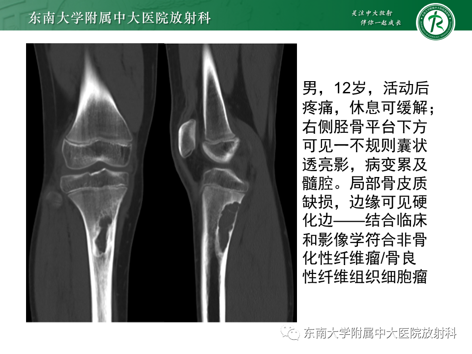 影像PPT - 【PPT】骨纤维异常增殖症-24