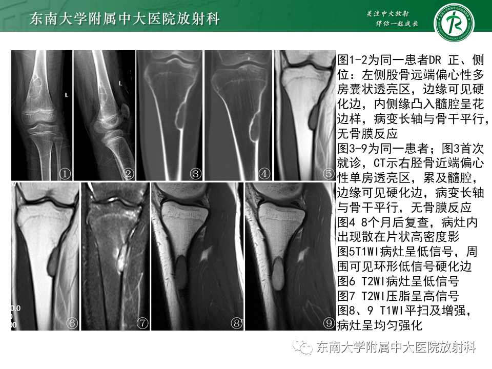 影像PPT - 【PPT】骨纤维异常增殖症-25