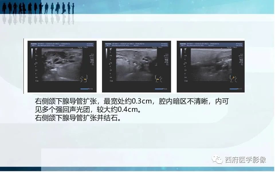 影像PPT - 【PPT】涎石症的影像诊断-3