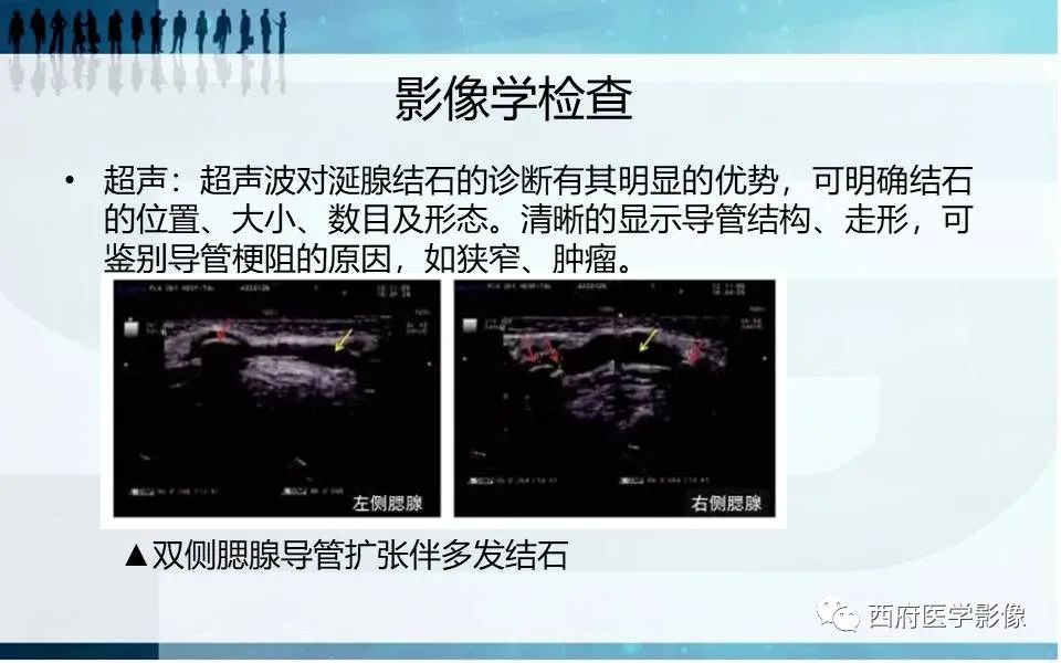 影像PPT - 【PPT】涎石症的影像诊断-21