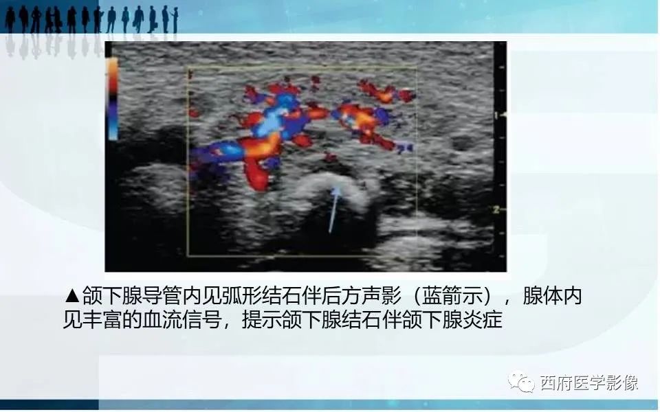 影像PPT - 【PPT】涎石症的影像诊断-22